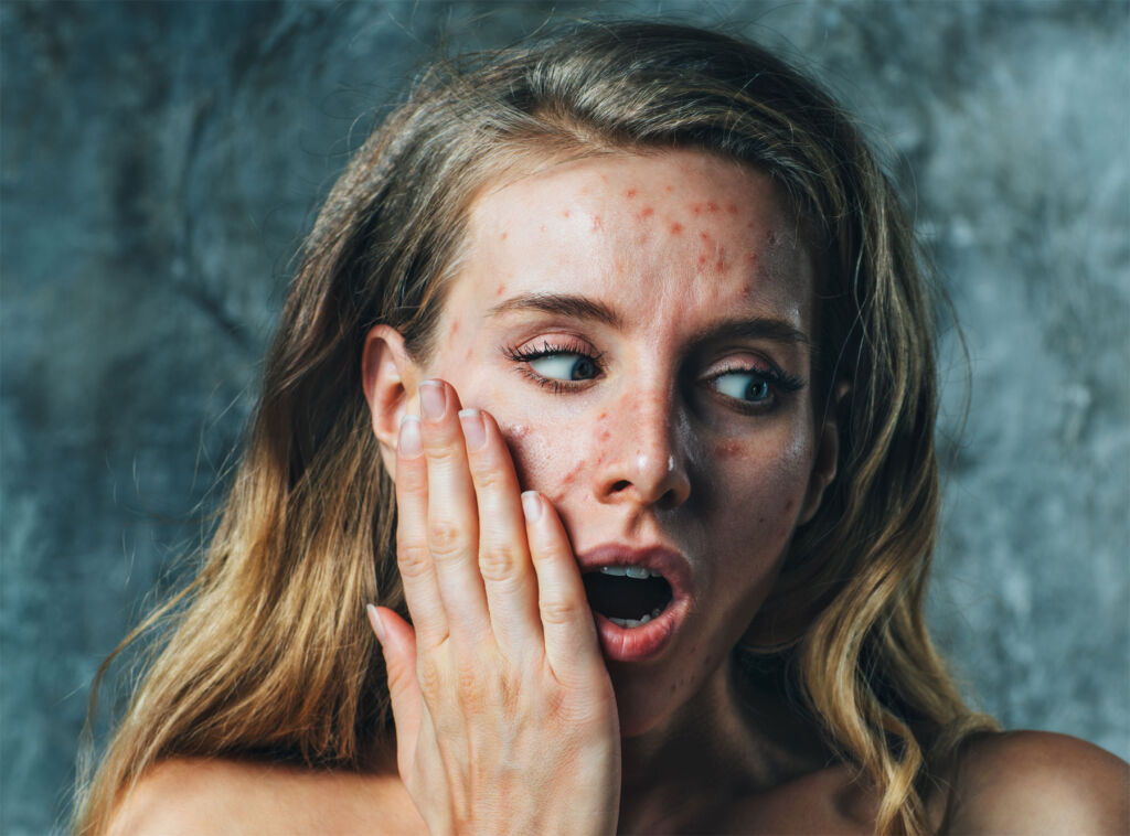 A woman shocked by her acne problem