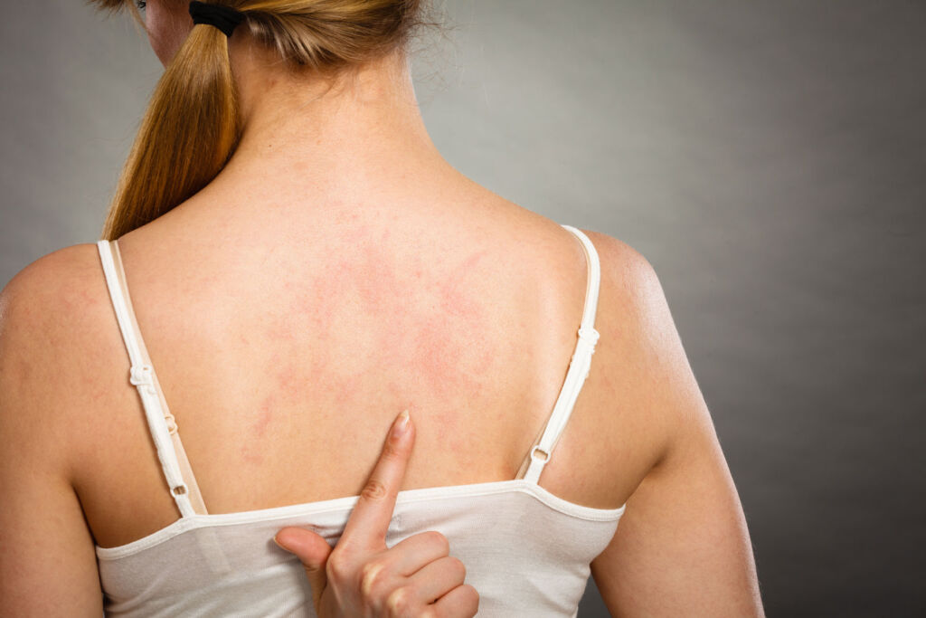 A young woman pointing to the eczema on her back